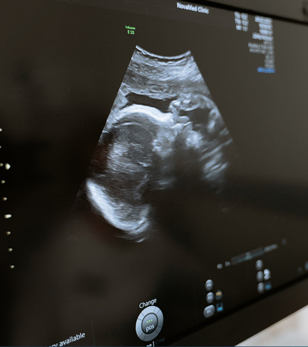 Equipos de Ultrasonido